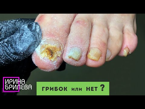 Видео: ГРИБОК или НЕТ ??? 🌸 Проблемный ПЕДИКЮР 🌸 Ирина Брилёва