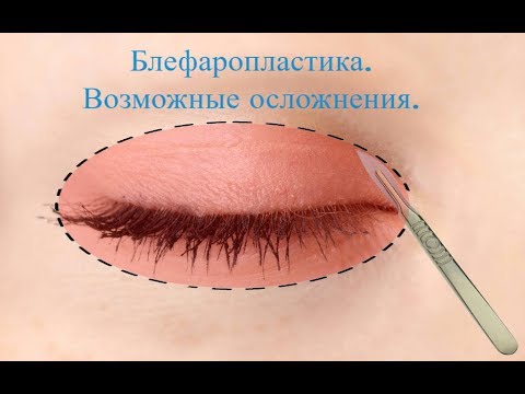 Видео: Блефаропластика. Возможные осложнения.
