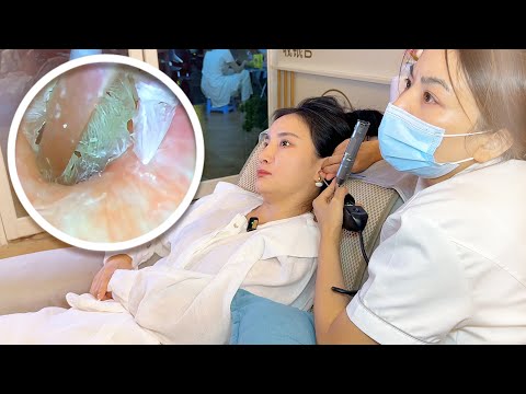 Видео: Визуальное ковыряние и чистка ушей