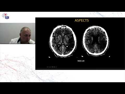 Видео: Экстренная нейровизуализация инсульта: что, когда и кому. к.м.н. Коновалов Родион Николаевич
