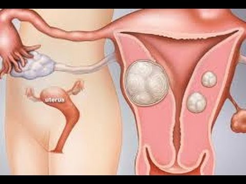 Видео: О фибромиомах матки @DrOlenaB