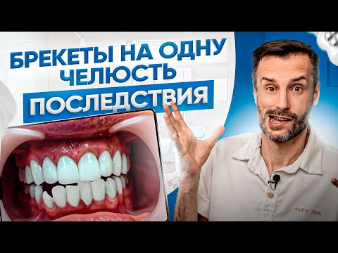 Видео: Почему брекеты ставят на обе челюсти? Установка брекетов на 1 «неправильную» челюсть