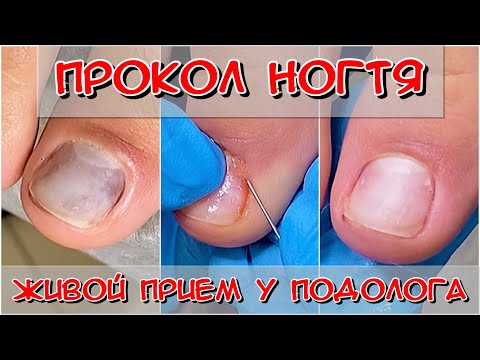 Видео: Прокол ногтя / зачем прокалывать ноготь / Подология / Живой прием / ушибла ноготь что делать?