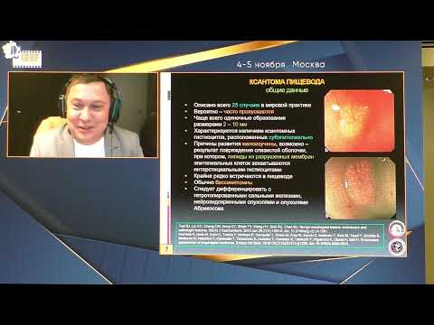 Видео: 60 Пирогов СС Что можно обнаружить в пищеводе при детальном эндоскопическом исследовании