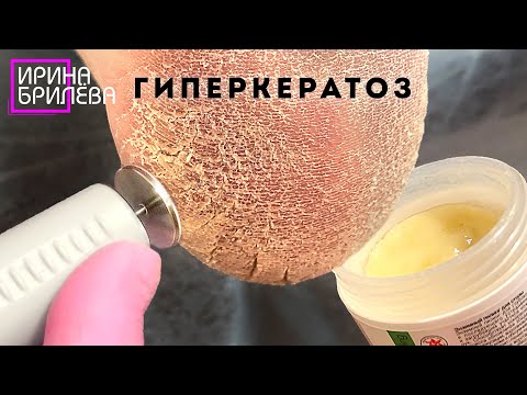 Видео: ПЕДИКЮР 🌸 Диски или препараты? 🌸 ГИПЕРКЕРАТОЗ 🌸 Ирина Брилёва