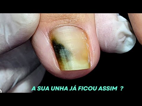 Видео: ЭТО КОГДА-НИБУДЬ СЛУЧАЛОСЬ С ВАШИМ НОГТЕМ? (с субтитрами)