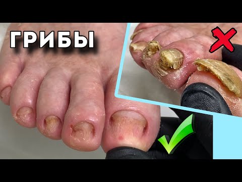 Видео: Зачистить инфицированные, пораженные ногти. Результат 100%. @podologmoscow