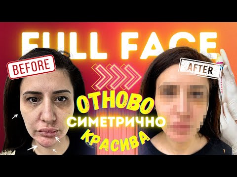 Видео: "ФИЛЪРИ ИЗКРИВИХА ЛИЦЕТО МИ" /ПЪЛНОТО ПРЕОБРАЗЯВАНЕ с д-р Петкова Е02/
