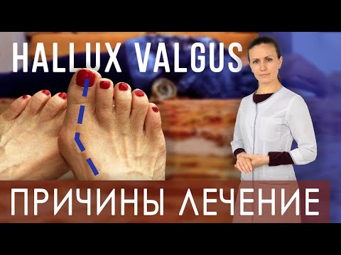 Видео: Косточка на ноге. Лечение Hallux valgus дома. Валик под спину | Как правильно лежать на валике