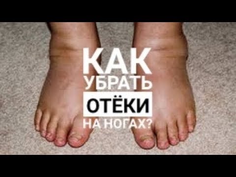 Видео: Как убрать отёки на ногах? Домашние способы и аптечные мази от отёков.