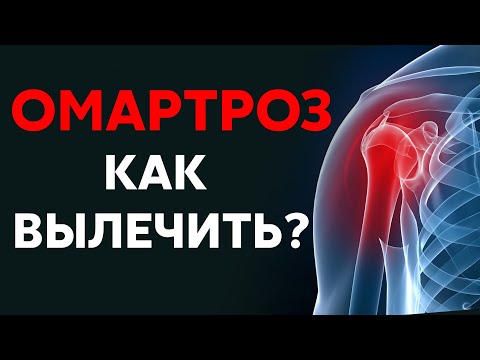 Видео: Артроз плечевого сустава - как вылечить?