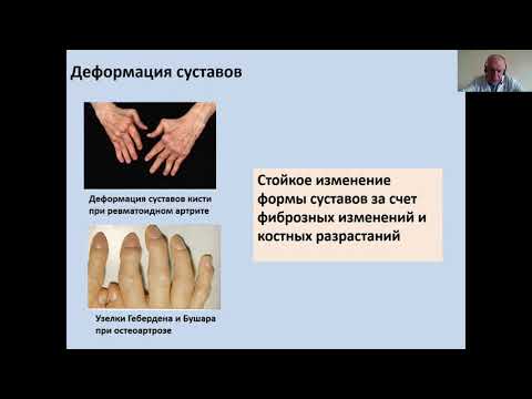 Видео: Дифференциальный диагноз при суставном синдроме