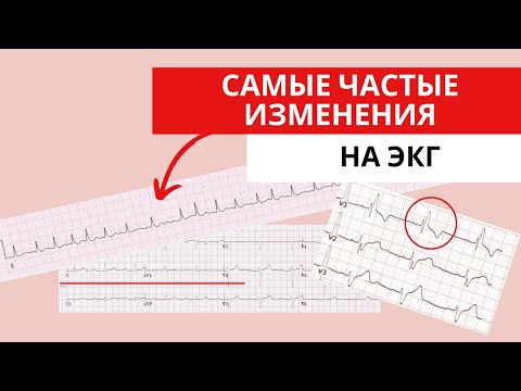 Видео: САМЫЕ ЧАСТЫЕ ОТКЛОНЕНИЯ НА ЭКГ.