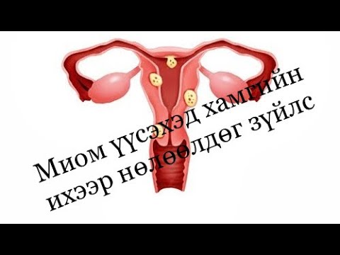 Видео: Умайн булчингийн хоргүй хавдар буюу миом үүсэхэд юу хамгийн их нөлөөллөг вэ?