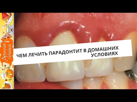 Видео: Как лечить парадонтит в домашних условиях