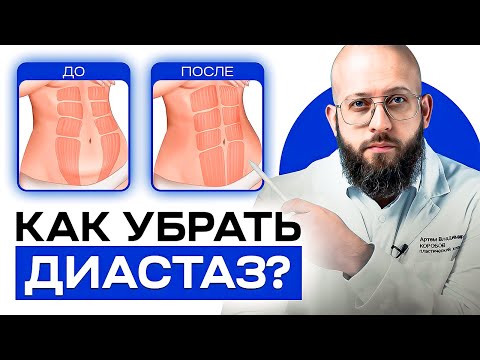 Видео: Что такое диастаз и как его определить. Методы лечения диастаза
