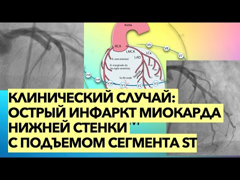 Видео: Клинический случай: острый инфаркт миокарда нижней стенки с элевацией сегмента ST