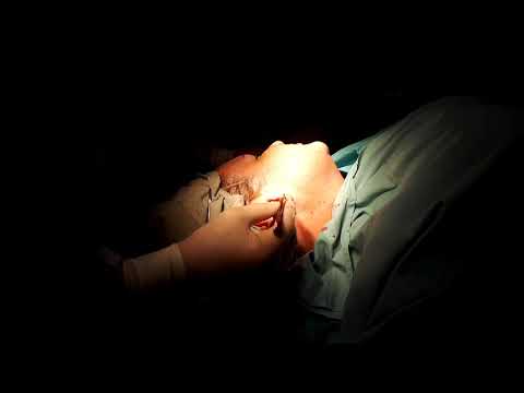 Видео: Ушивание мочки уха последствия ношения тяжелых серег