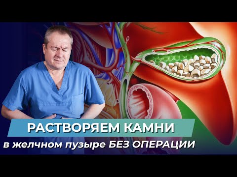 Видео: Почему появляются камни в желчном пузыре и как их избежать?
