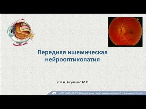 Видео: Передняя ишемическая нейрооптикопатия. к.м.н. Акуленко М.В.