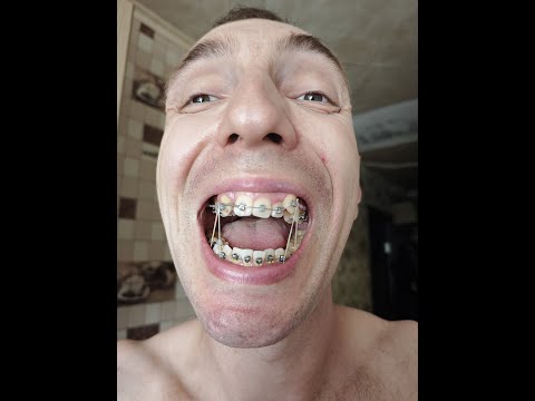 Видео: 5 серия. Установка нижних брекетов.
