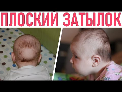 Видео: У РЕБЕНКА ПЛОСКИЙ ЗАТЫЛОК | У каких детей чаще бывает плоский затылок