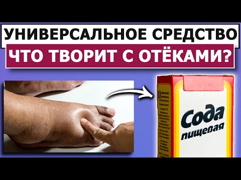 Видео: ОТЕКИ УЙДУТ НАВСЕГДА. Лечение отеков