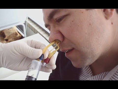 Видео: Лечение гайморита у взрослых без прокола. Проведение ЯМИК процедуры при лечении гайморита.