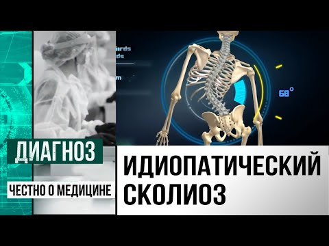 Видео: Искривление позвоночника: хирурги устраняют сколиоз с помощью инновационных технологий | Диагноз