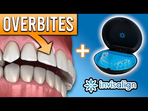 Видео: Может ли Invisalign исправить перекус и другие проблемы с прикусом? | Premier Orthodontics