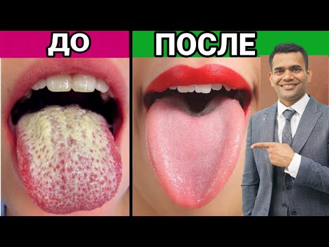 Видео: Лучший Способ Вылечить Кандидоз И Дрожжи