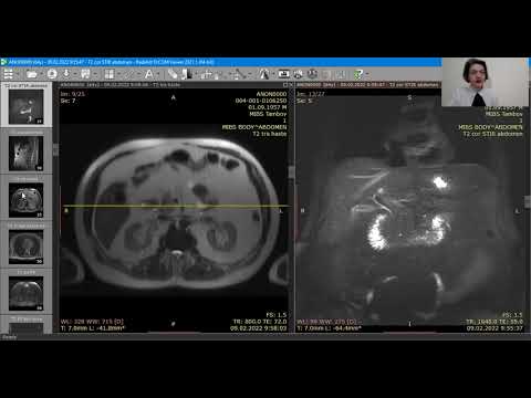 Видео: МРТ в диагностике желчекаменной болезни