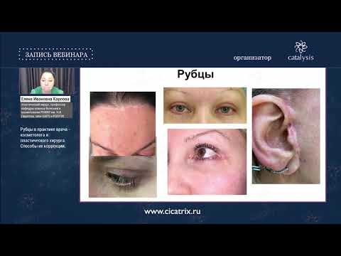 Видео: Вебинар: Рубцы в практике косметолога и пластического хирурга. Способы коррекции.