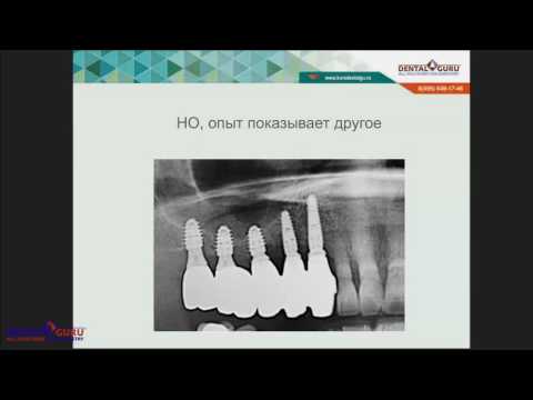 Видео: 2017 06 20 Короткие имплантаты альтернатива костной пластики Обзор научных исследований личный опыт