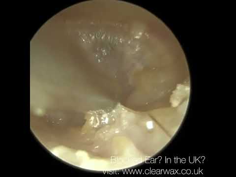 Видео: 1613 — Удаление ушной серы выявило множественные патологии уха