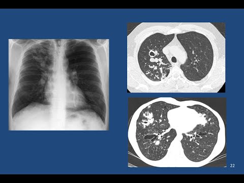 Видео: Лучевая диагностика воспалительных поражений легких