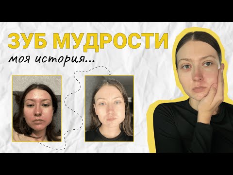 Видео: УДАЛЕНИЕ ЗУБА МУДРОСТИ // сложное удаление | советы перед удалением | больно или нет