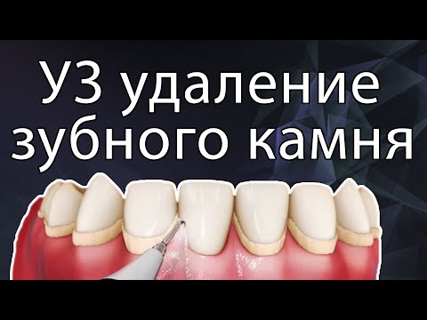 Видео: Удаление наддесневых отложений