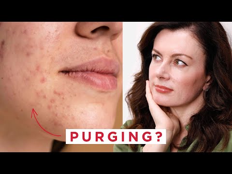 Видео: Очищение от прыщей — что это такое и как с этим успешно справиться | Доктор Сэм Бантинг