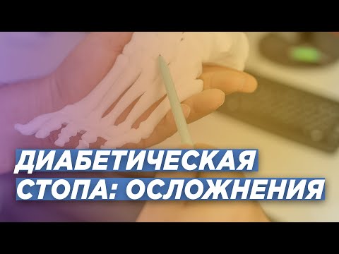 Видео: ОСЛОЖНЕНИЯ НА ФОНЕ ДИАБЕТИЧЕСКОЙ СТОПЫ. СТОПА ШАРКО.   ТРАВМАТОЛОГ-ОРТОПЕД ДМН ИГОРЬ ПАХОМОВ.