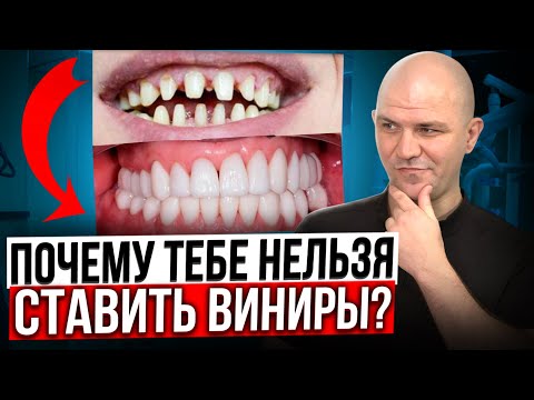 Видео: Вся правда про виниры! Кому стоит ставить? Сколько стоят виниры и сколько они прослужат?