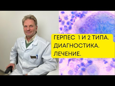 Видео: ГЕРПЕС 1 и 2 типа. Какие анализы не информативны? Какое лечение бесполезно?