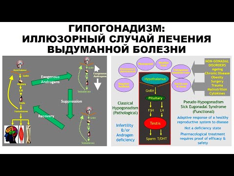 Видео: ГИПОГОНАДИЗМ: ИЛЛЮЗОРНЫЙ СЛУЧАЙ ЛЕЧЕНИЯ ВЫДУМАННОЙ БОЛЕЗНИ