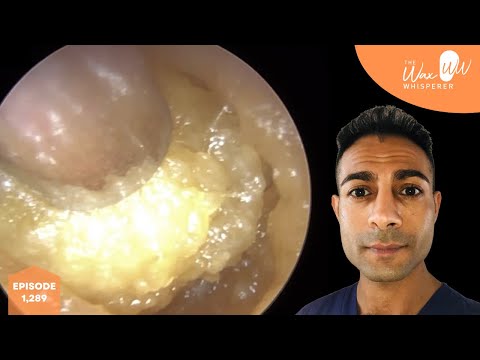 Видео: 1289 — удаление крупных отмерших кожных пробок и ушной серы