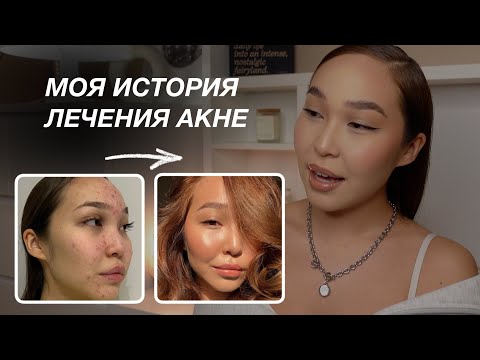 Видео: МОЯ ИСТОРИЯ: как я вылечила акне?