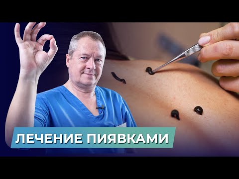 Видео: ЛЕЧЕНИЕ ПИЯВКАМИ: зачем нужны, показания и противопоказания к лечению