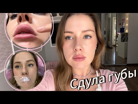 Видео: УДАЛИЛА ГУБЫ | О ЧЕМ МОЛЧАТ КОСМЕТОЛОГИ | ЛОНГИДАЗА МОЙ ОПЫТ