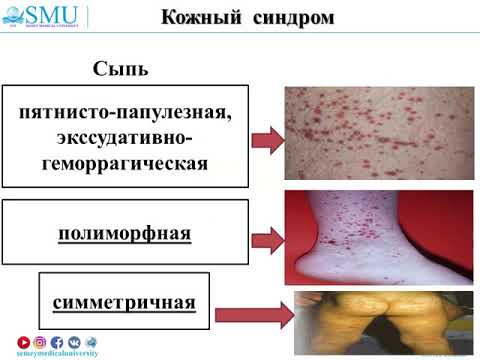 Видео: Геморрагический васкулит