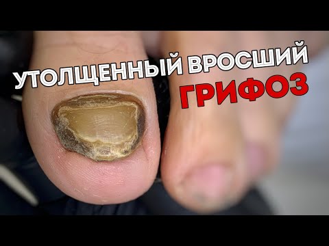 Видео: Много кожи в боковых валиках. Чистка ногтя онихогрифоз