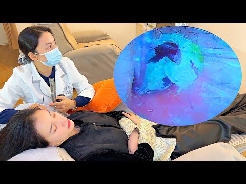 Видео: 🔍Микроскопическая визуальная чистка ушей ASMR! Полная запись СПА-чистки ушных каналов!